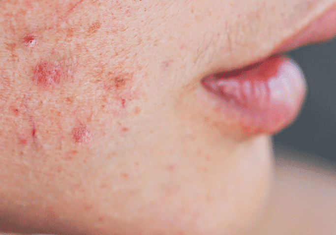 Inflammation